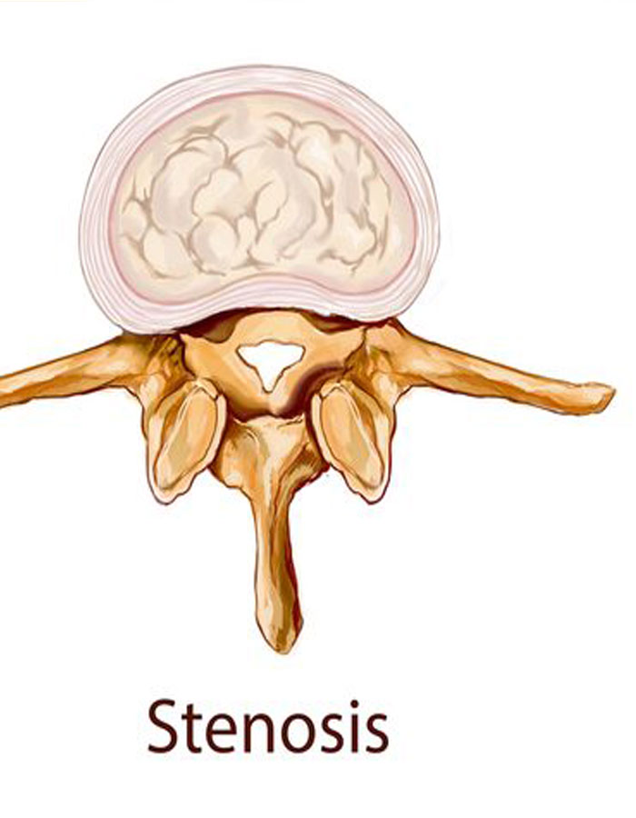 stenose1
